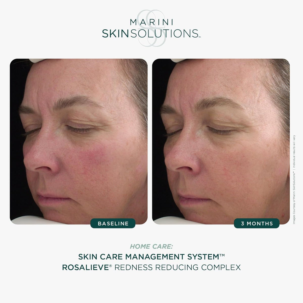 Marini Skin Solutions RosaLieve Redness Reducing Complex