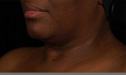 SkinMedica® Neck Correct Neck and Décolleté Cream 1.7 Oz. / 50 ml